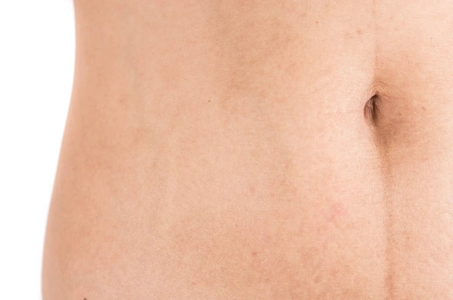 How to Address Stomach Wrinkles For Smoother Skin