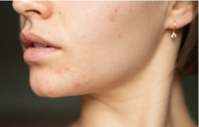 How to Tell if Acne is Hormonal or Bacterial?