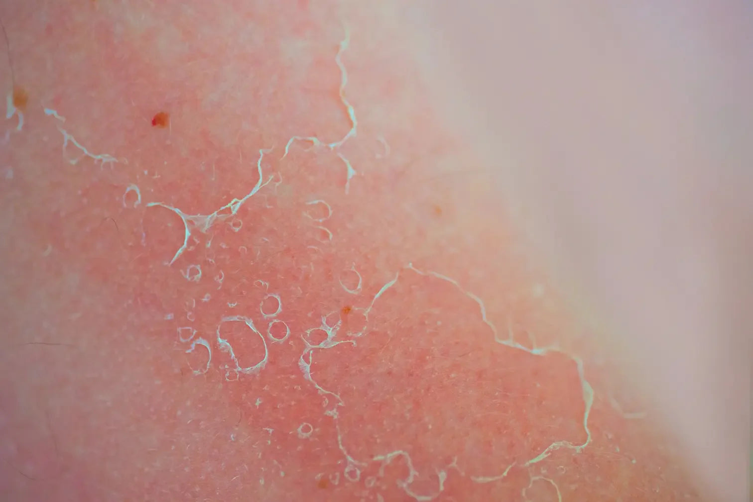 Why is My Skin Peeling on My Face?