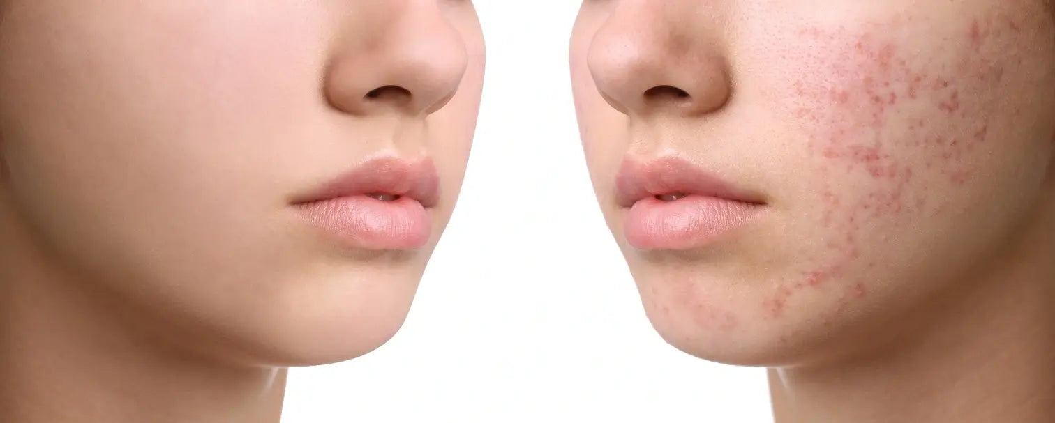 Understanding Hormonal Acne and Its Triggers
