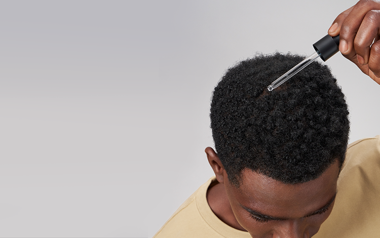 Is Male PCOS The Missing Link In Premature Male Pattern Balding?