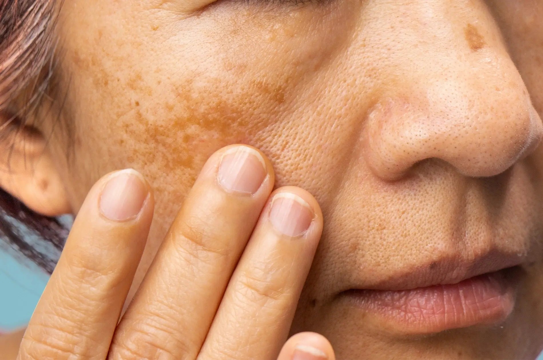 What Is Melasma On Face Causes Treatment OneSkin what-is-melasma-on-face-causes-treatment-oneskin