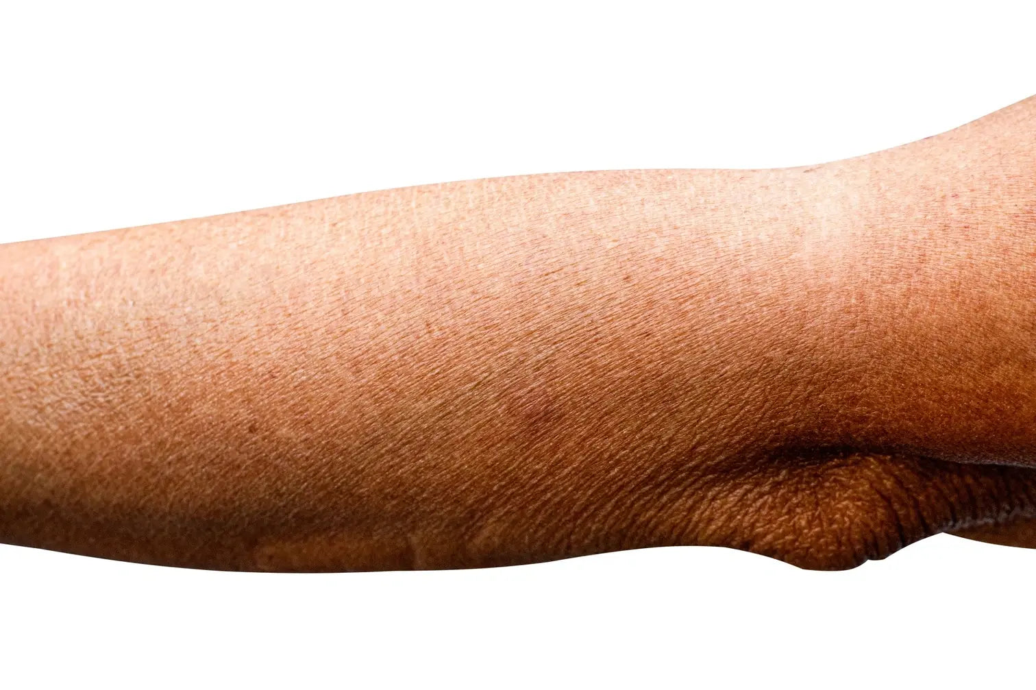 A Scientific Approach to Addressing Wrinkly Skin on Arms