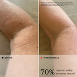 Before-and-after skin texture comparison on an arm, with a beige panel at the bottom showing the text '70% reported visibly smoother texture' and a small citation note at the top.