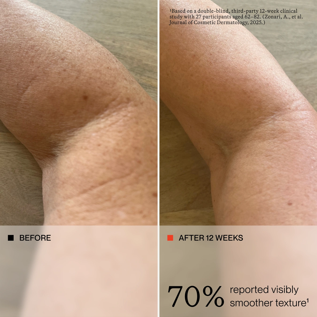 Before-and-after skin texture comparison on an arm, with a beige panel at the bottom showing the text '70% reported visibly smoother texture' and a small citation note at the top.