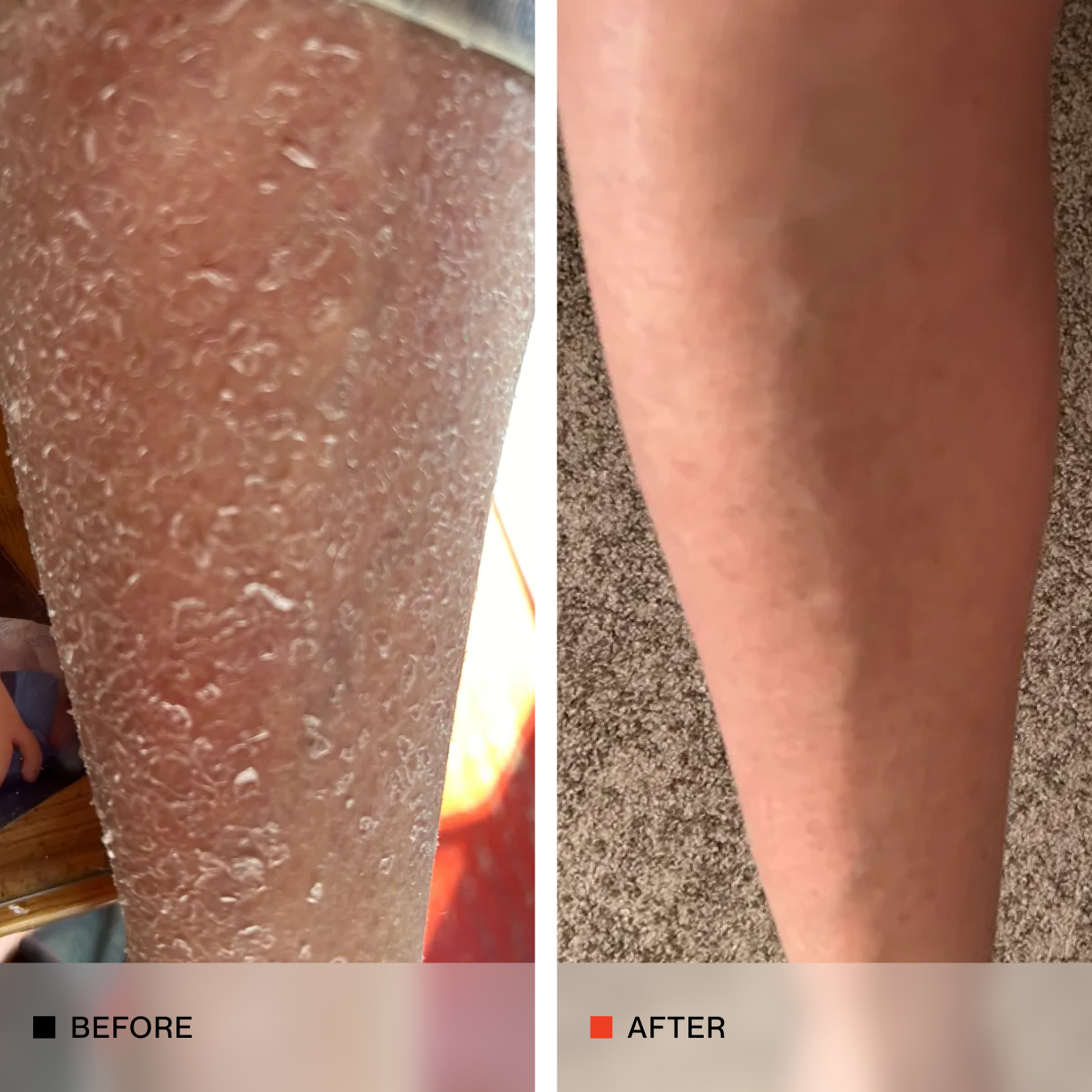 A side-by-side before and after comparison of a human leg, showing a dramatic reduction in dry, cracked, and bubbly skin on the left and smoother, healthier skin on the right.