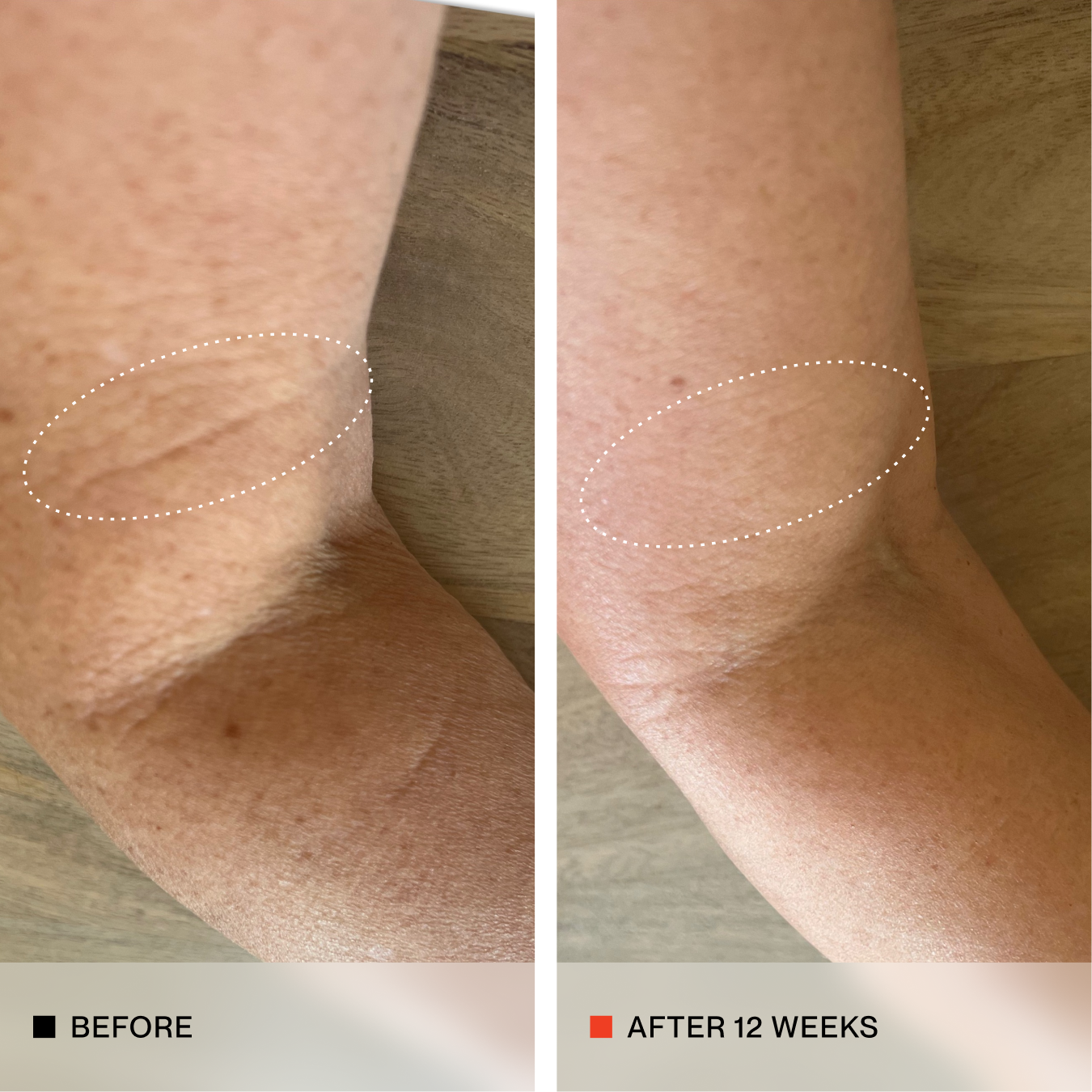 A side-by-side before and after comparison of an elbow showing skin texture and hyperpigmentation improvement over 12 weeks. The left panel is labeled 'BEFORE' with a black square icon, and the right panel is labeled 'AFTER 12 WEEKS' with a red square icon.