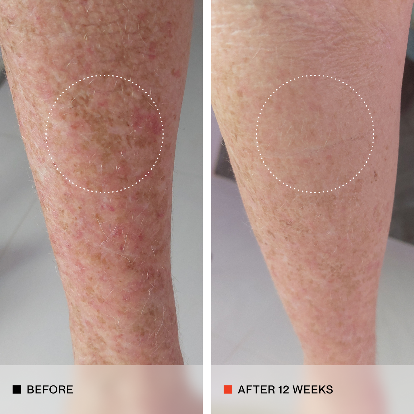 A side-by-side before and after comparison of a human leg showing skin improvement over 12 weeks. The left panel is labeled BEFORE and shows sun-damaged, reddish, scaly skin with a circled area highlighting the condition.