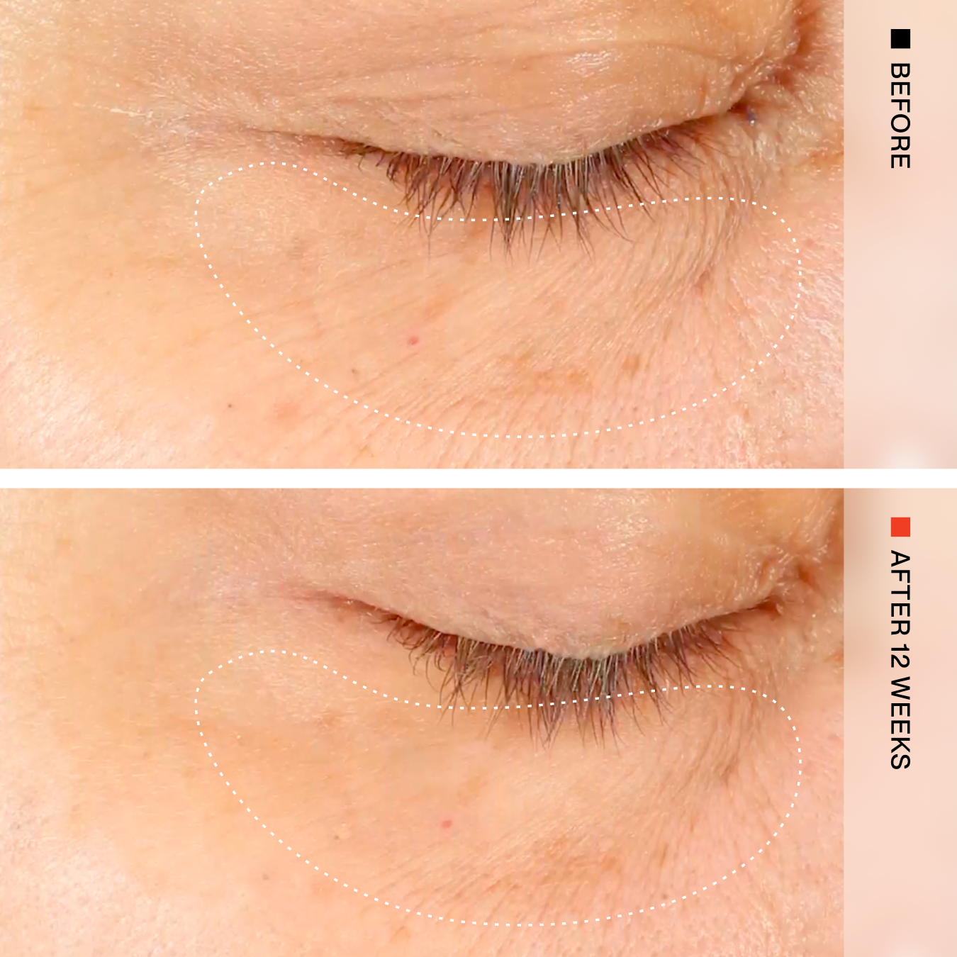 Before-and-after comparison of a closed eye showing skin texture and wrinkles around the eyelid, with dotted white outlines highlighting the treated area. The top panel is labeled BEFORE and the bottom panel is labeled AFTER 12 WEEKS.