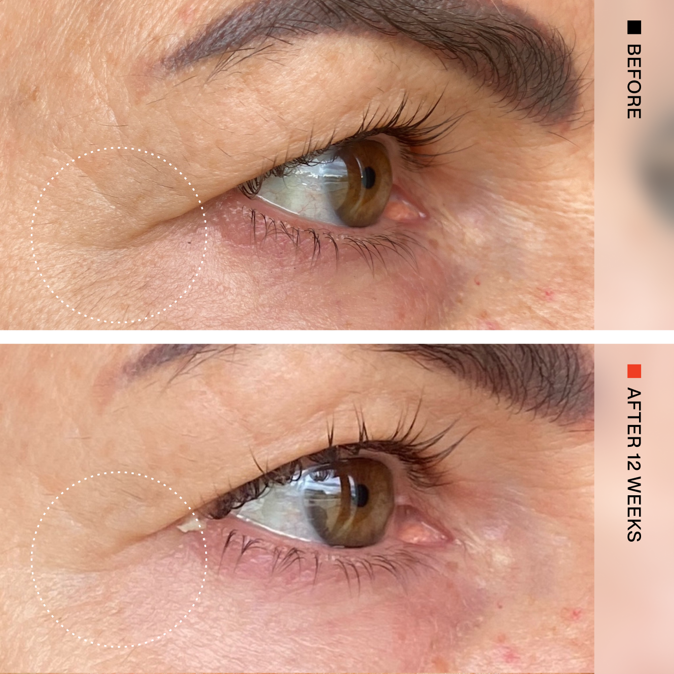 Before-and-after comparison of a person's eye area showing skin texture and wrinkles around the eye, with text reading 'BEFORE' and 'AFTER 12 WEEKS' on a beige sidebar.