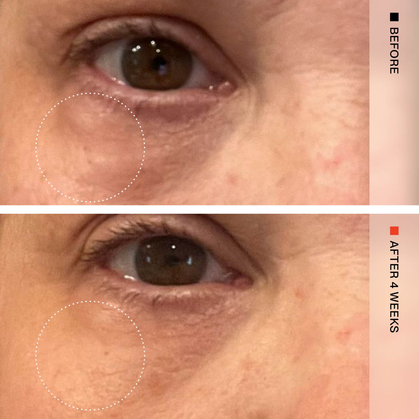 Before-and-after comparison of under-eye dark circles on a person's face, with the top labeled BEFORE and the bottom labeled AFTER 12 WEEKS. The image shows close-up views of the left eye area with a dotted circle highlighting the skin region.