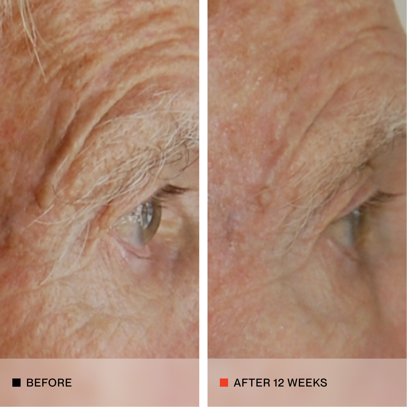 A side-by-side close-up comparison of an older person's eye and forehead, labeled 'BEFORE' on the left and 'AFTER 12 WEEKS' on the right, showing reduced wrinkles and sun damage over 12 weeks.