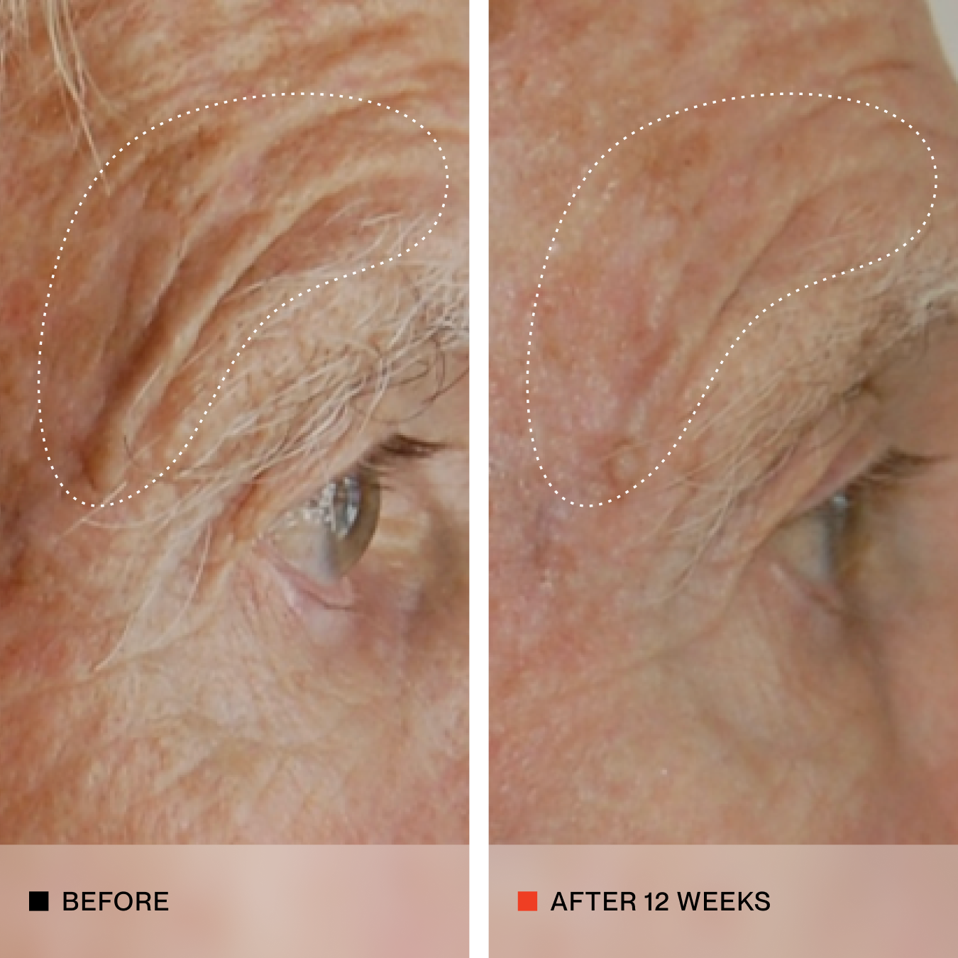 Side by side images of a person's skin with more elasticity, the left image is before and the right image is after 12 weeks