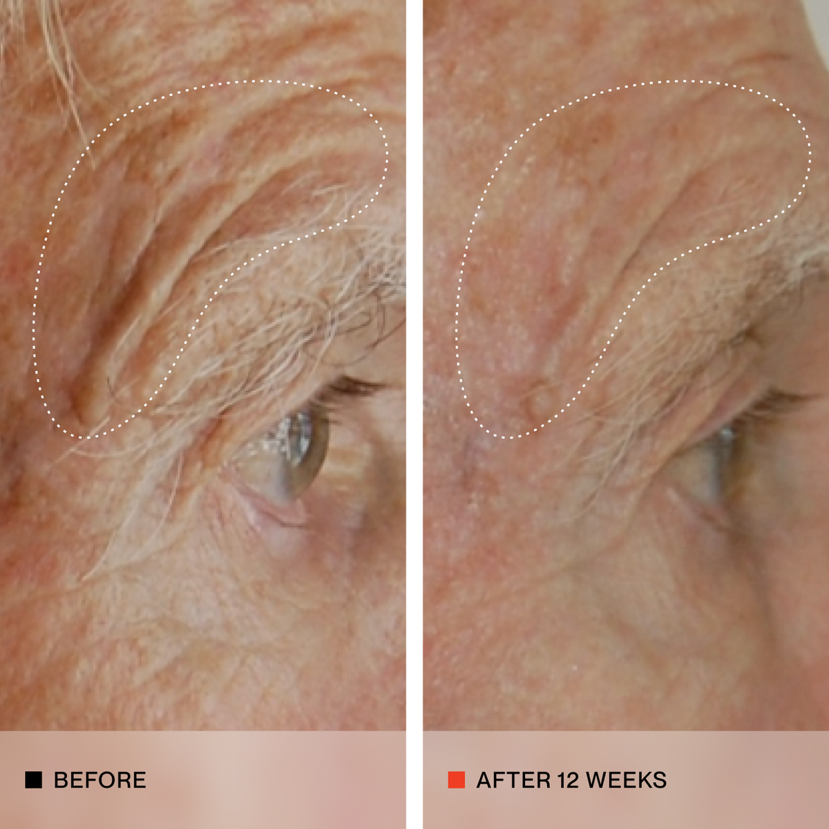 A side-by-side close-up comparison of an older person's eye and forehead, labeled 'BEFORE' on the left and 'AFTER 12 WEEKS' on the right, showing reduced wrinkles and sun damage over 12 weeks.