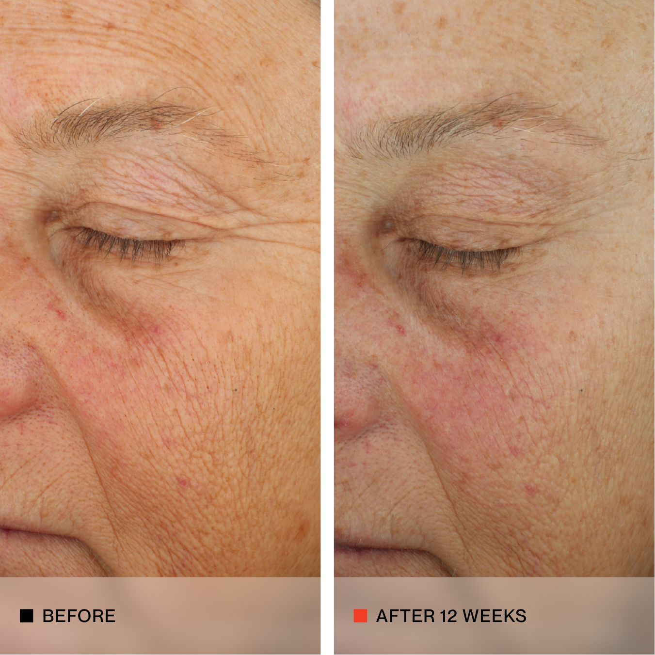 A side-by-side before and after comparison of an older woman's eye and cheek area, showing skin texture and wrinkles. The left panel is labeled 'BEFORE' and the right panel is labeled 'AFTER 12 WEEKS'.