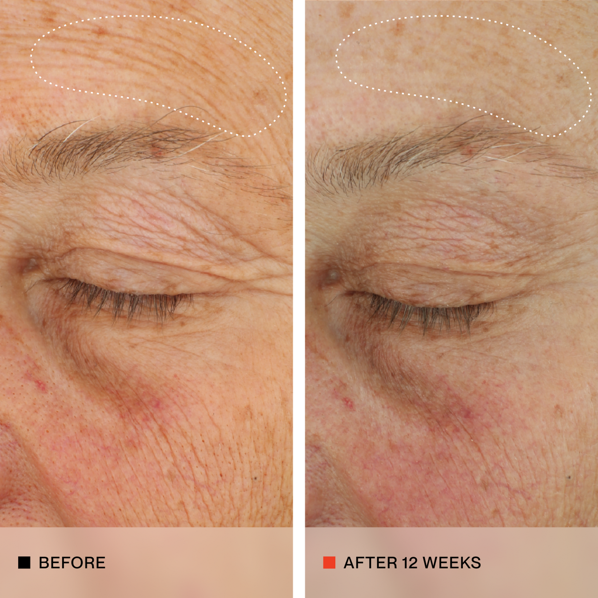 A side-by-side before and after comparison of an older woman's eye and cheek area, showing skin texture and wrinkles. The left panel is labeled 'BEFORE' and the right panel is labeled 'AFTER 12 WEEKS'.
