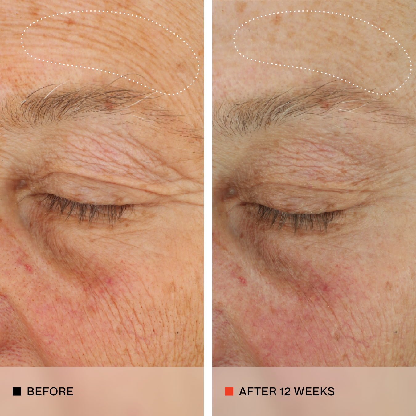 A side-by-side before and after comparison of an older person's forehead and eyebrow area, showing wrinkles and sun damage. The left panel is labeled BEFORE and shows more wrinkles around the eyebrow and forehead; the right panel is labeled AFTER 12 WEEKS and shows visibly smoother skin and reduced wrinkles.