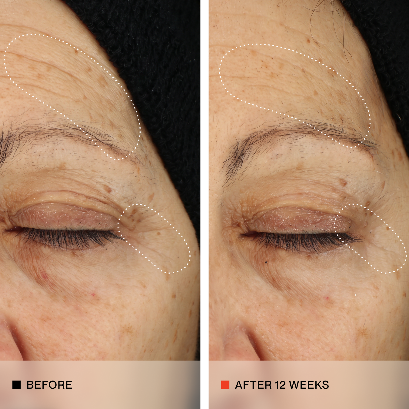 Side-by-side close-up of an older woman's eye area labeled 'BEFORE' and 'AFTER 12 WEEKS,' showing skin texture and wrinkle improvement with dotted white outlines highlighting treated areas.