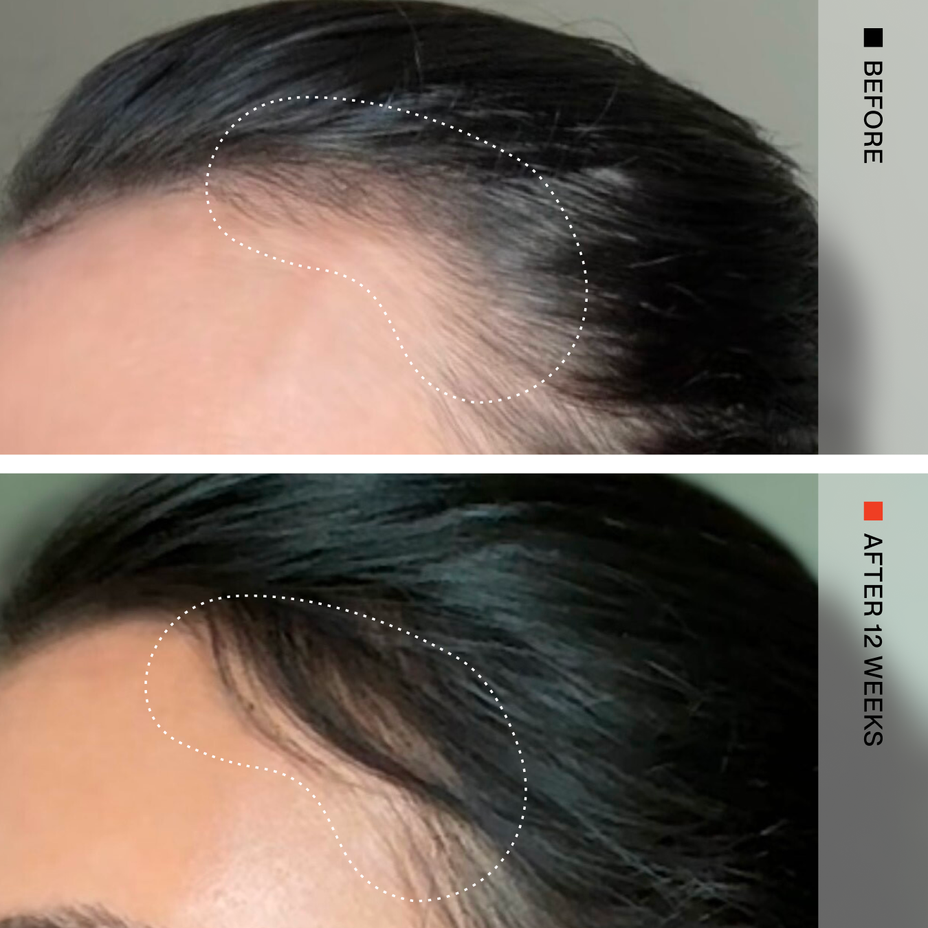 Before-and-after comparison of a person's hairline, showing hair growth progress over 12 weeks. The top panel is labeled 'BEFORE' and shows a thinning hairline outlined in a dotted white shape.