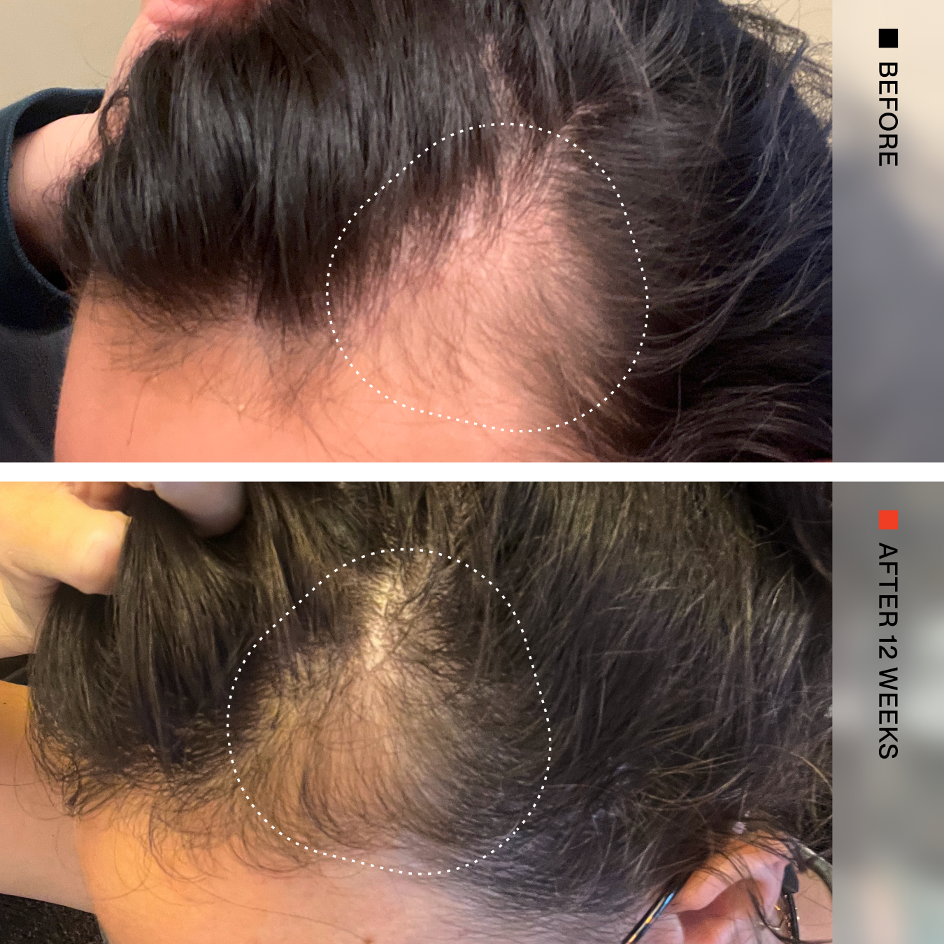 A before-and-after comparison of a person's scalp showing hair growth results. The top photo is labeled BEFORE and shows a visible hairline recession with dark hair and a white dotted circle highlighting the scalp.