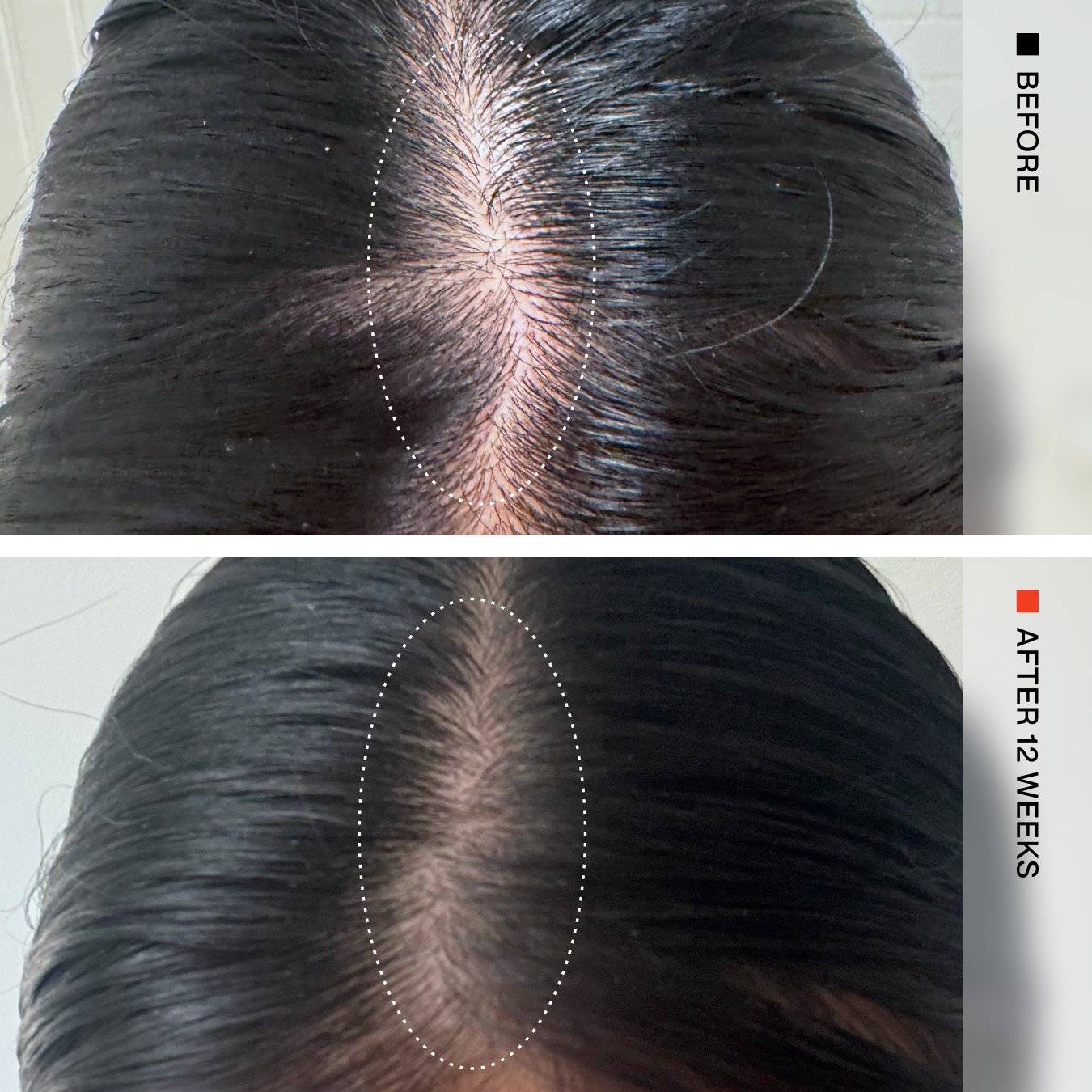 Before-and-after comparison of a person's scalp hairline, showing a wider part line and healthier-looking hair after 12 weeks. The top panel is labeled BEFORE and shows darker hair with a visible part line; the bottom panel is labeled AFTER 12 WEEKS and shows a finer, less visible part line.