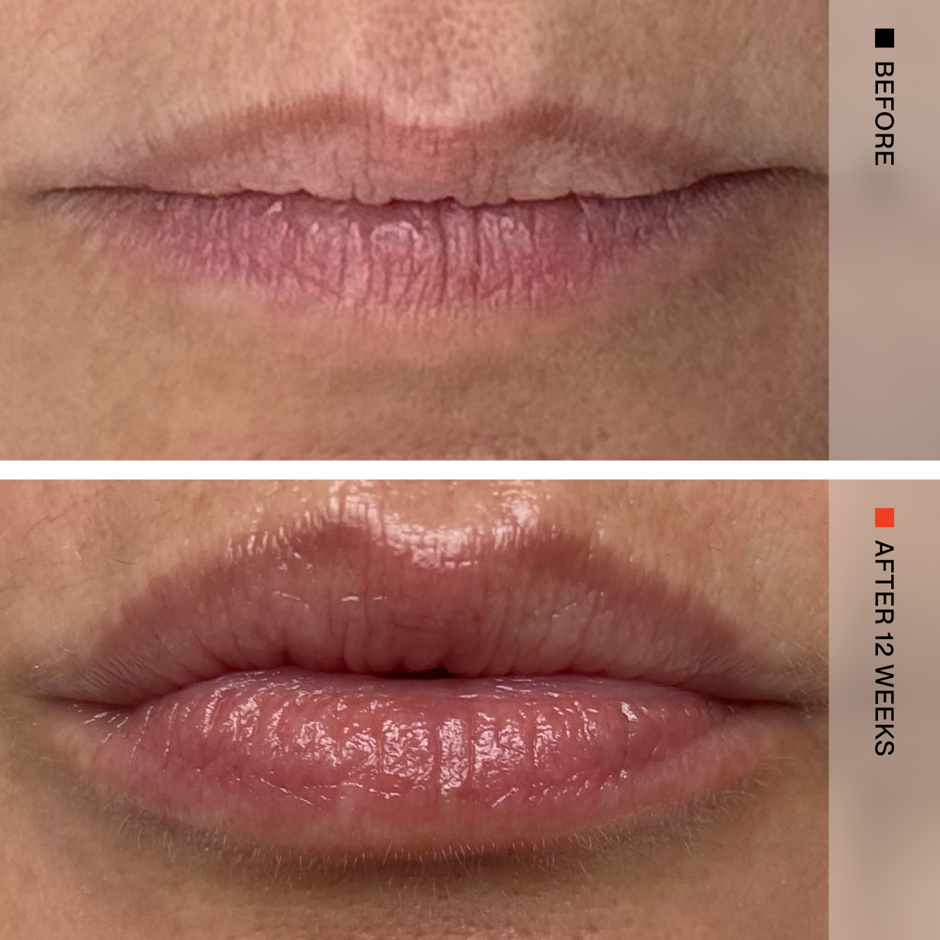 Close-up before-and-after comparison of a person's lips, with the top labeled BEFORE and the bottom labeled AFTER 12 WEEKS. The lower lip appears more hydrated and glossy in the after view.