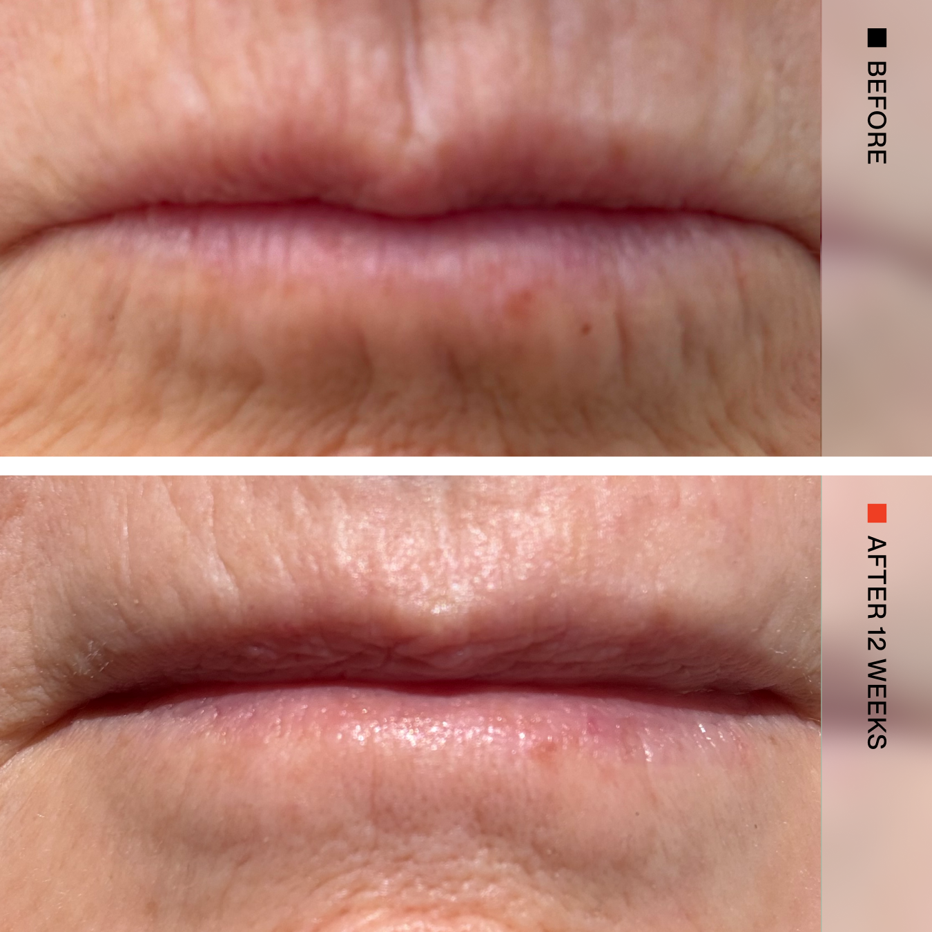 Close-up before-and-after comparison of lips, with the top panel labeled BEFORE and the bottom panel labeled AFTER 12 WEEKS. The image shows skin texture and lip condition over time.