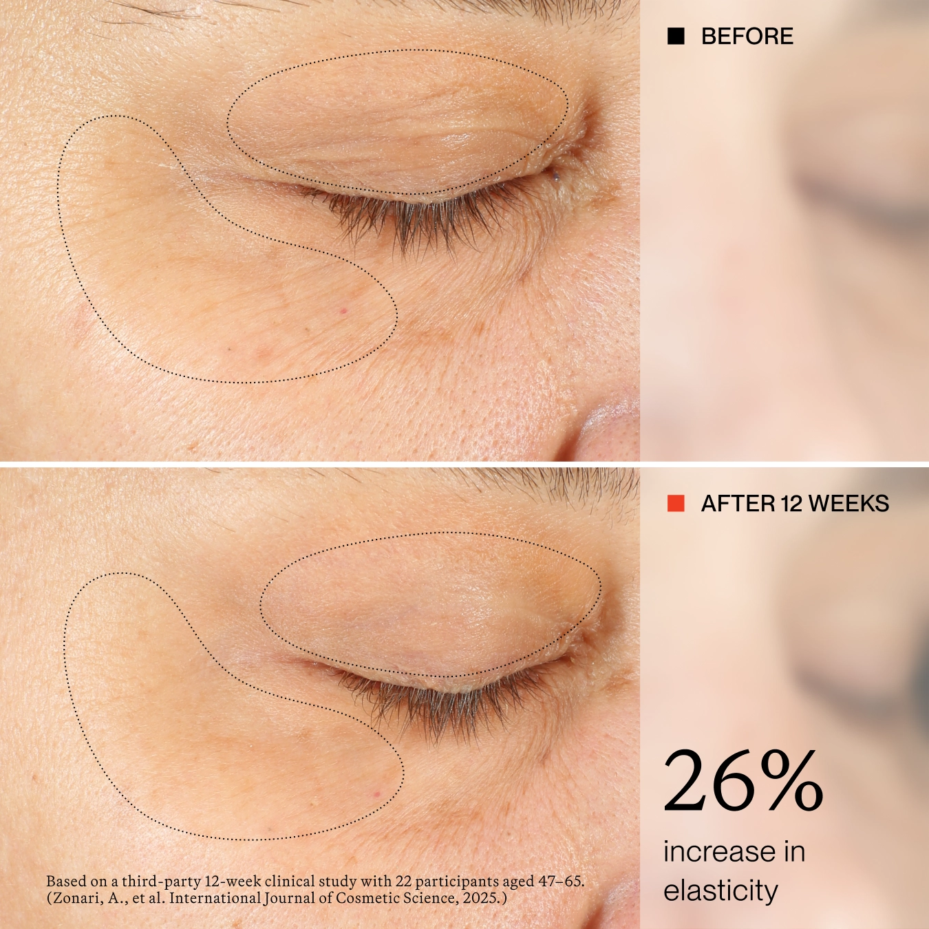 Before-and-after comparison of an eye area showing skin elasticity improvement over 12 weeks, with dotted outlines highlighting the treated region and text stating '26% increase in elasticity'.
