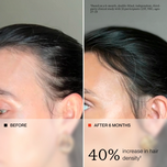 Before-and-after comparison of a person's hairline showing increased hair density after 6 months, with text stating '40% increase in hair density'.