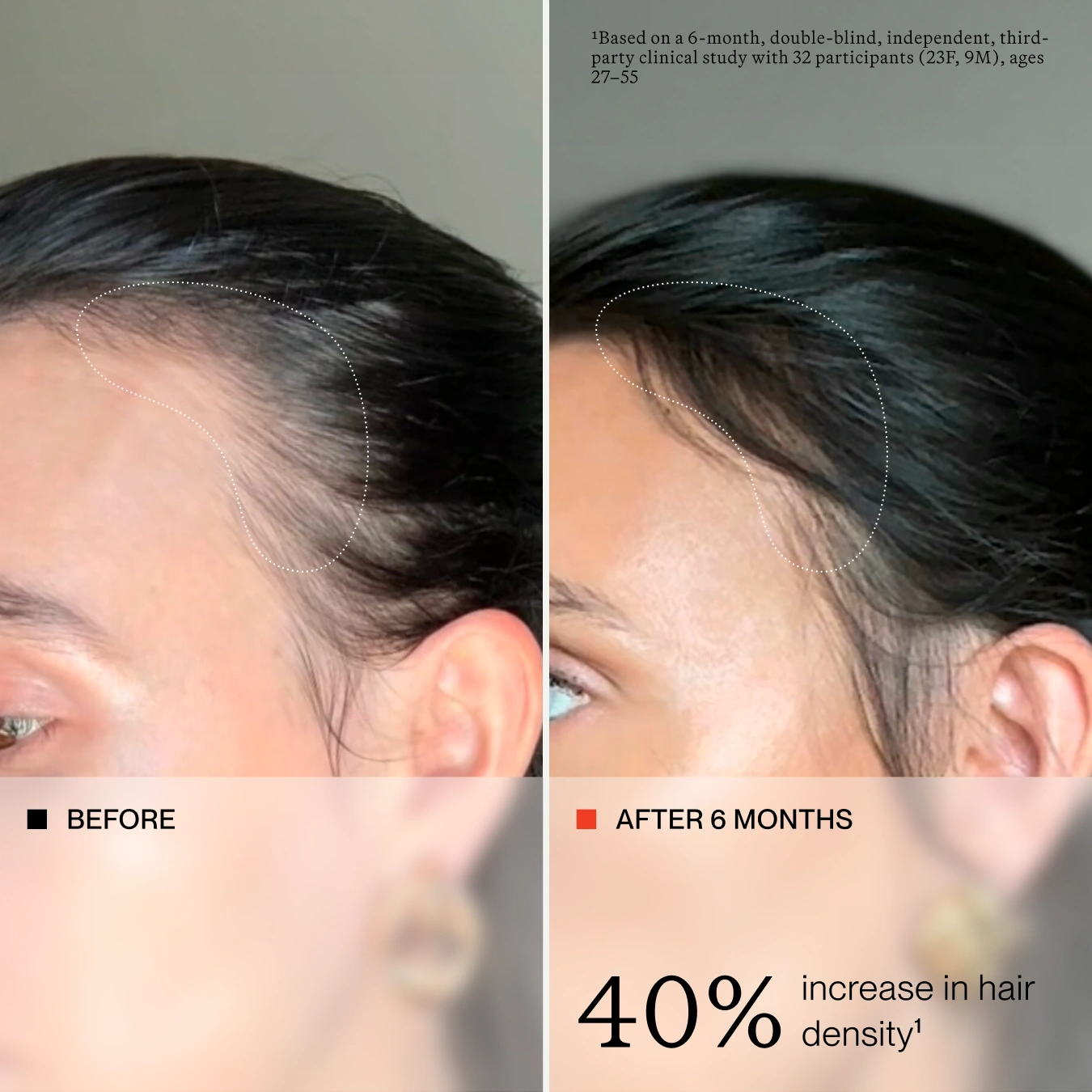 Before-and-after comparison of a person's hairline showing increased hair density after 6 months, with text stating '40% increase in hair density'.